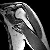 МРТ плечевого сустава